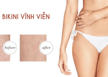 Máy triệt lông ipl nào tốt ? Cùng 4 kinh nghiệm triệt lông tại nhà