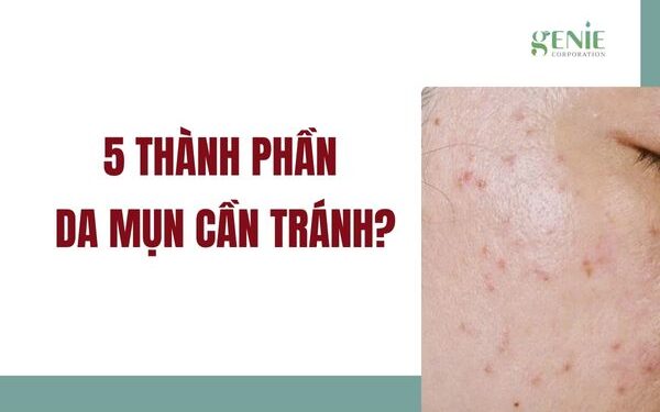 5 thành phần da mụn cần tránh? Nguyên nhân gây mụn phổ biến ở da